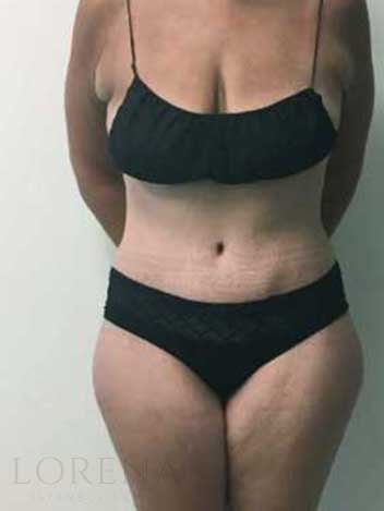 Abdominoplastie avant apres 1