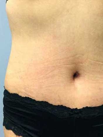 Abdominoplastie avant apres 2