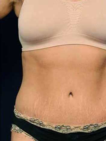 Abdominoplastie avant apres 3