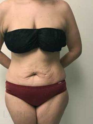 Abdominoplastie avant apres 1