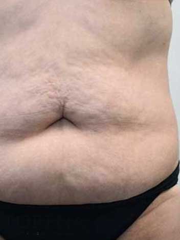 Abdominoplastie avant apres 2