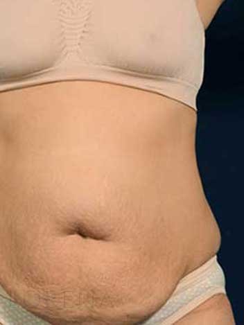 Abdominoplastie avant apres 3