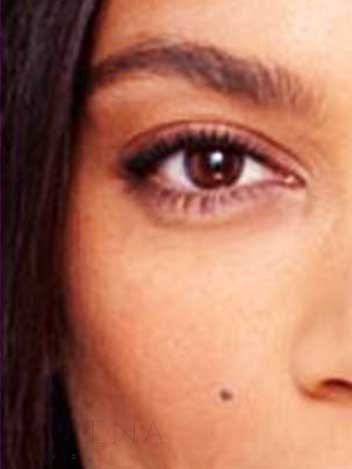 Blepharoplastie avant apres 1