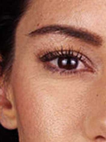 Blepharoplastie avant apres 2