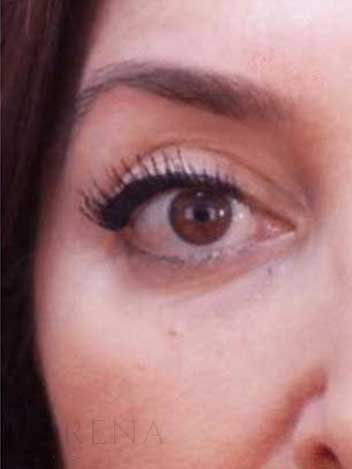 Blepharoplastie avant apres 3