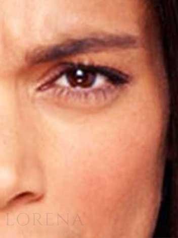Blepharoplastie avant apres 1