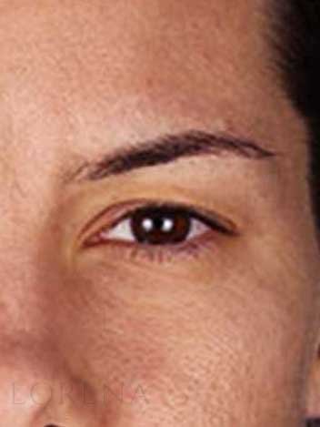 Blepharoplastie avant apres 2