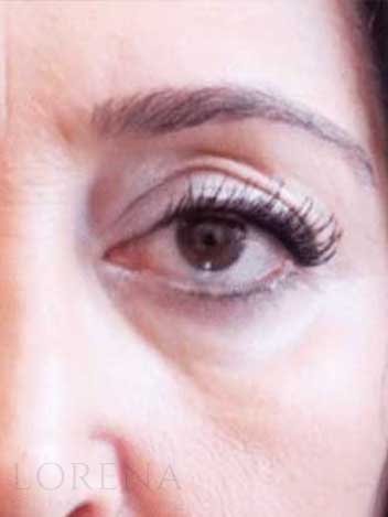 Blepharoplastie avant apres 3