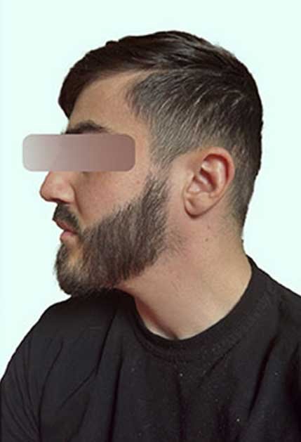 Greffe de barbe Istanbul avant apres