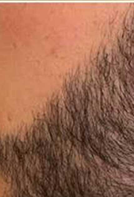 Greffe de barbe avant apres 2