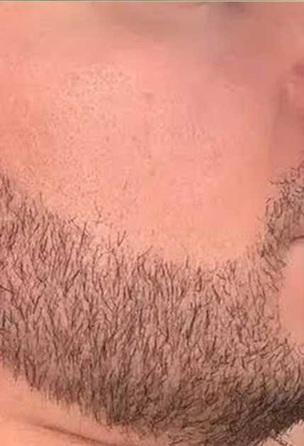Greffe de barbe avant apres 3