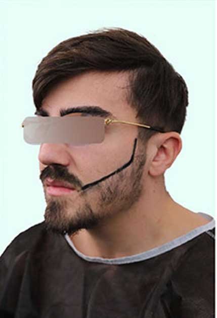 Greffe de barbe Istanbul avant apres