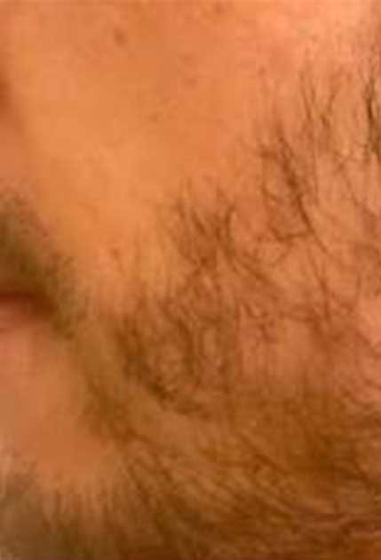 Greffe de barbe avant apres 2