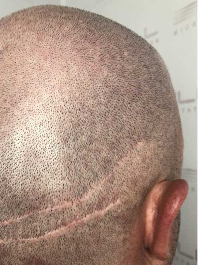 Greffe de cheveux Turquie avant apres FUE Saphir