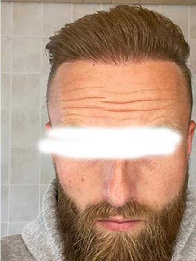 Greffe de cheveux DHI avant apres 2