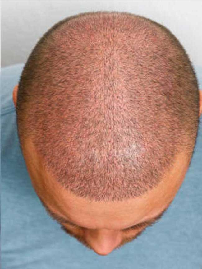 Greffe de cheveux DHI avant apres 3