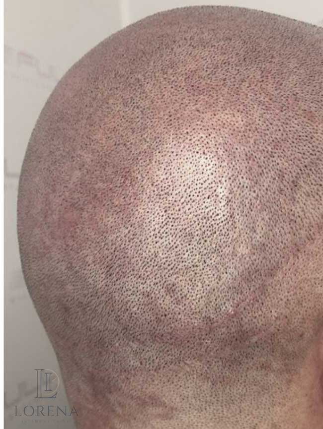 Greffe de cheveux Turquie avant apres FUE Saphir