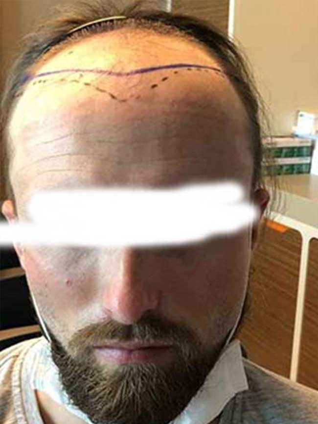 Greffe de cheveux DHI avant apres 2