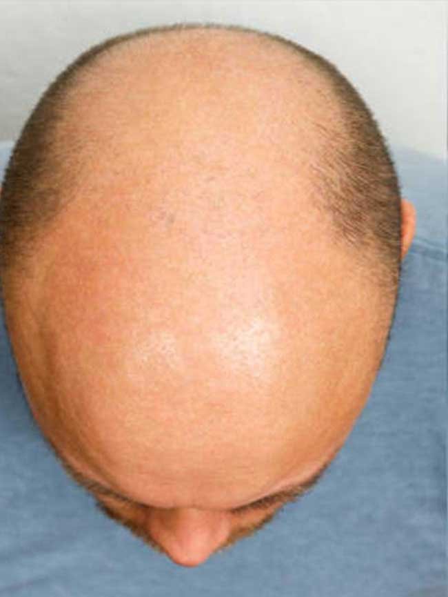 Greffe de cheveux DHI avant apres 3