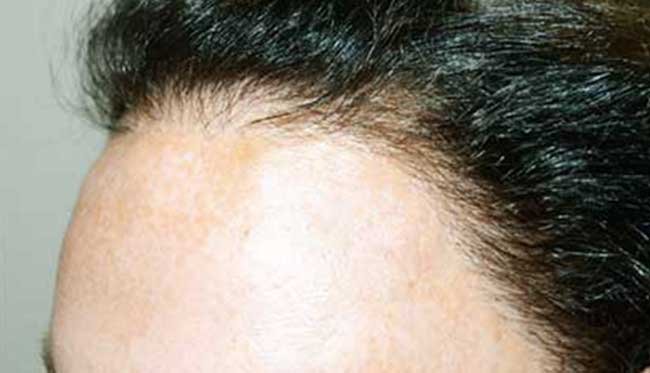 Greffe de cheveux femme Turquie avant apres