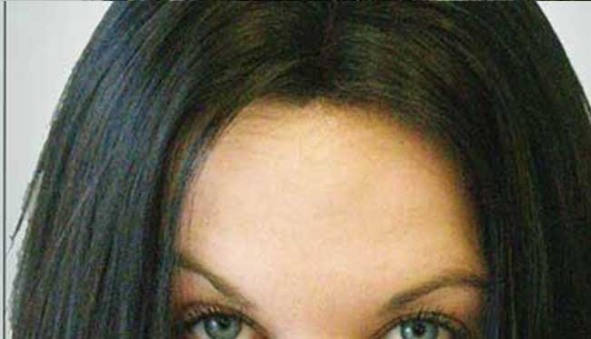 Greffe de cheveux femme avant apres 2