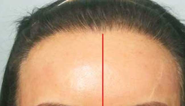 Greffe de cheveux femme avant apres 3