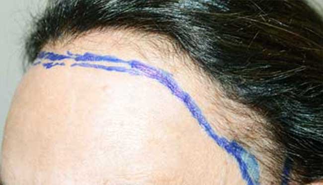 Greffe de cheveux femme Turquie avant apres