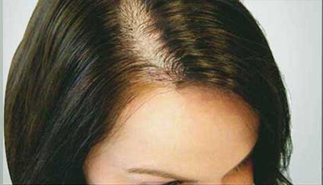 Greffe de cheveux femme avant apres 2
