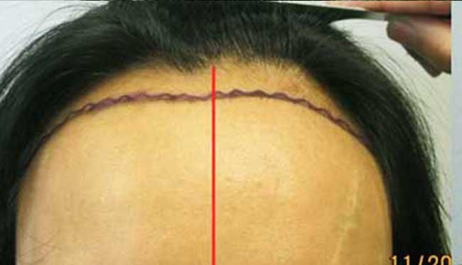 Greffe de cheveux femme avant apres 3
