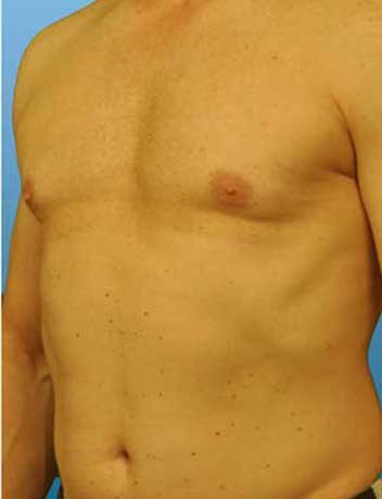 Gynecomastie avant apres 1