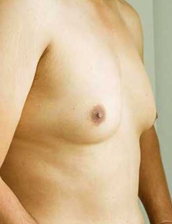 Gynecomastie avant apres 3