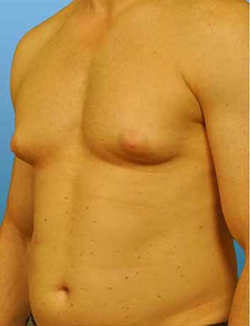 Gynecomastie avant apres 1