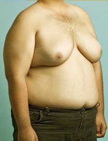 Gynecomastie avant apres 2