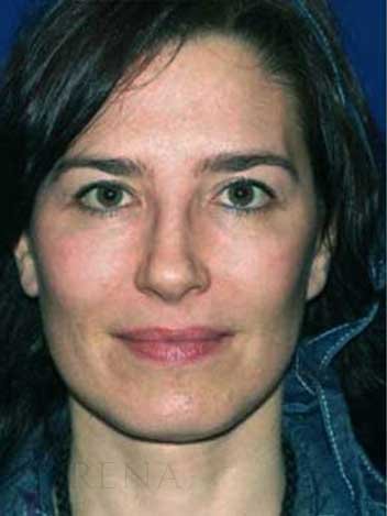 Lifting visage avant apres 1