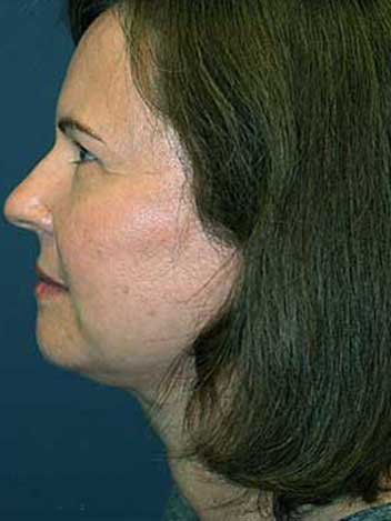 Lifting visage avant apres 2