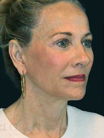 Lifting visage avant apres 3