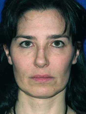 Lifting visage avant apres 1
