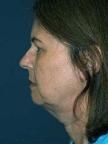 Lifting visage avant apres 2