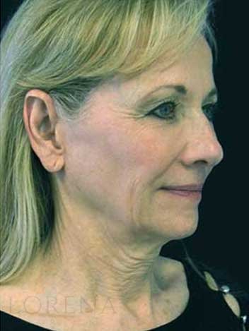 Lifting visage avant apres 3