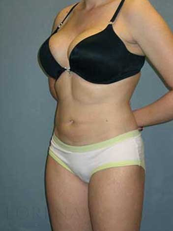 Mommy Makeover avant apres 3