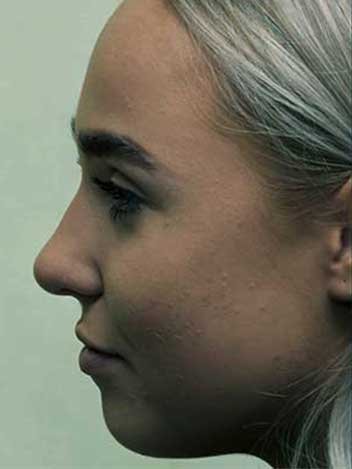 Avant après rhinoplastie