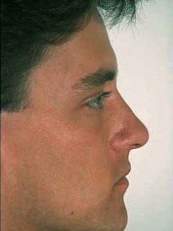 Rhinoplastie homme Turquie