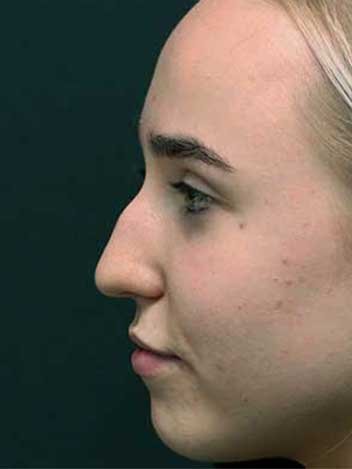 Avant après rhinoplastie