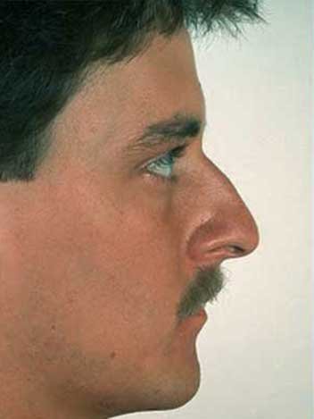 Rhinoplastie homme Turquie