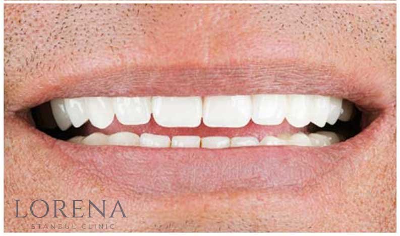 Refaire ses dents en Turquie