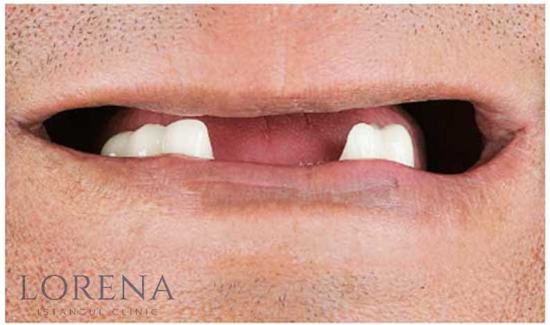 Refaire ses dents en Turquie